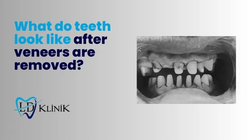 What do teeth look like after veneers are removed?