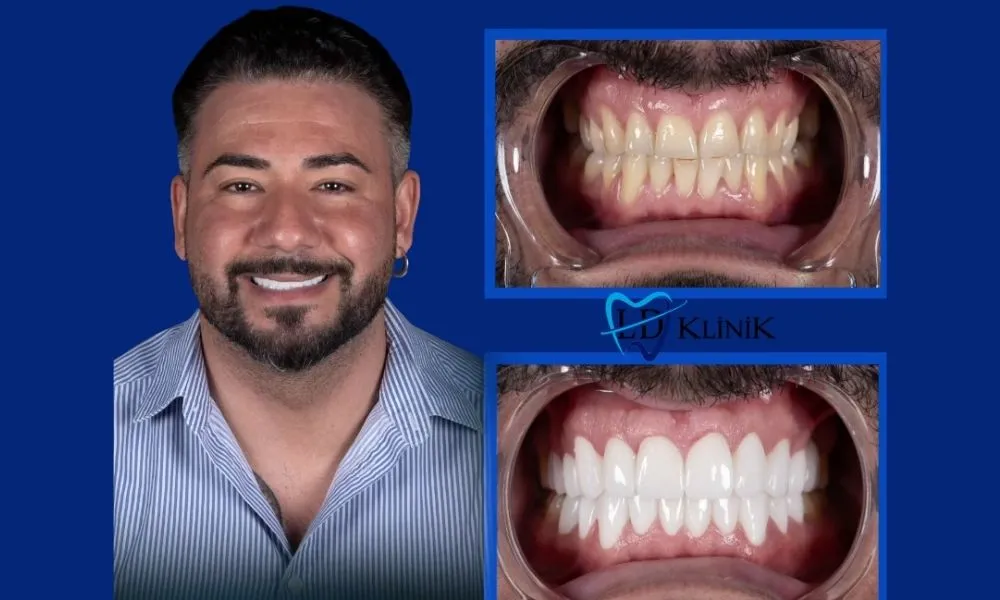 Dental crowns before and after in Turkey