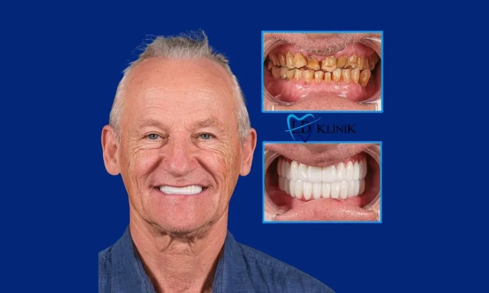 Dental crowns before and after photo in Antalya