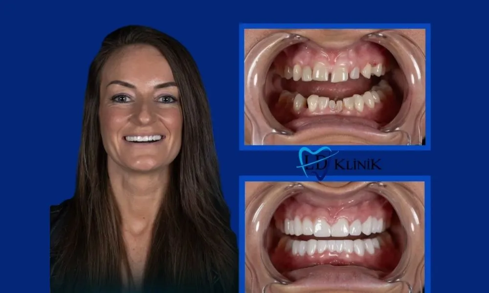 Dental crowns before and after in Antalya, Turkey