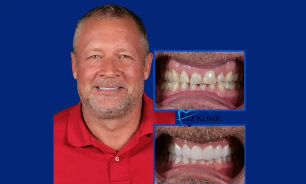 Zirconia crowns before and after in Antalya, Turkey
