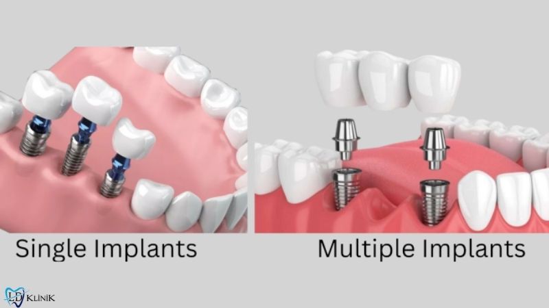 Multiple dental implants Turkey