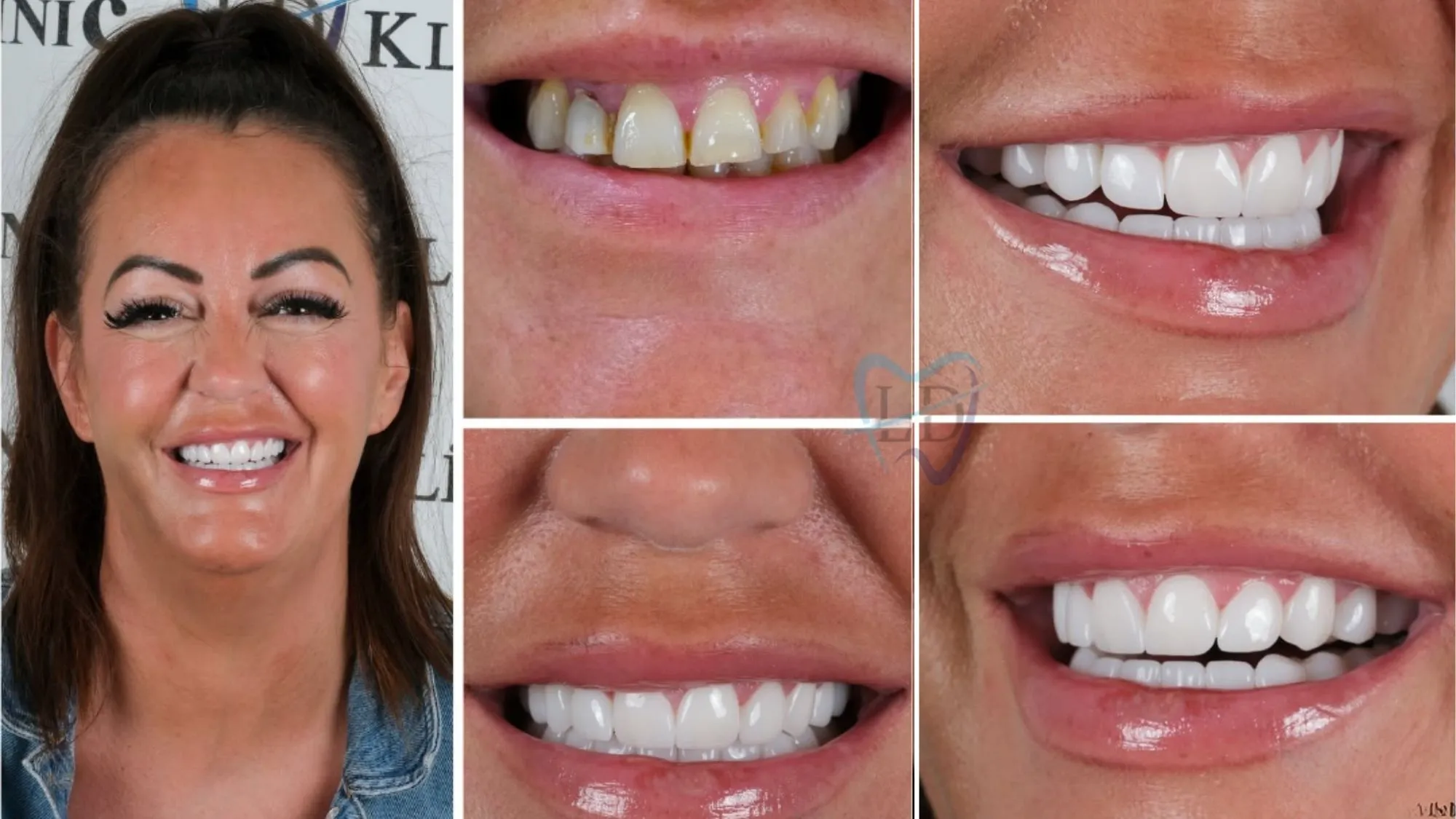Is Hollywood Smile Worth It?