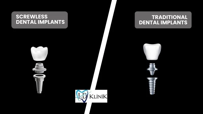 What Are Screwless Dental Implants?