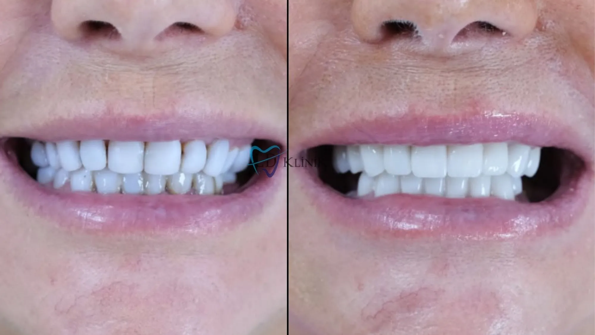 Signs of Bad Veneers