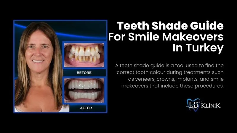 Teeth shade guide in Antalya