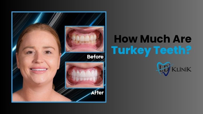 How Much Are Turkey Teeth?