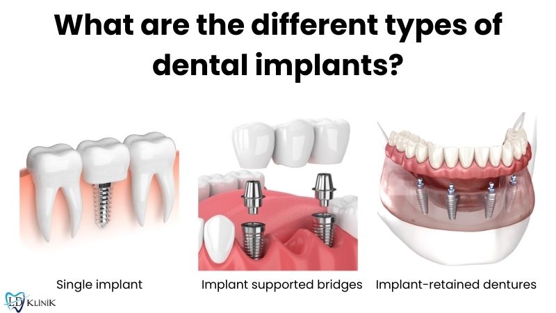 Different types of dental implants