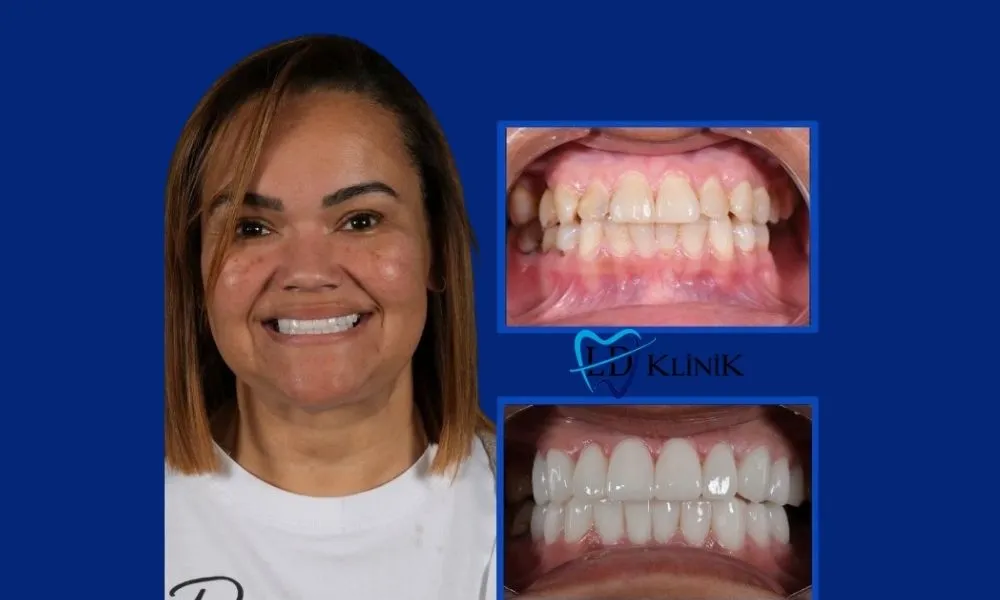 Dental crowns before and after