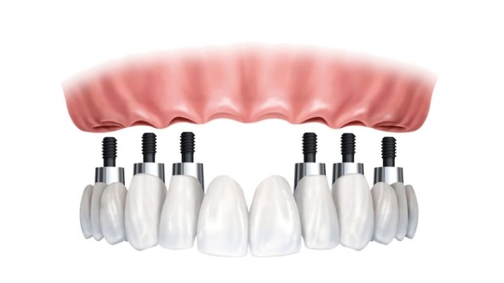 Antalya All on six implants