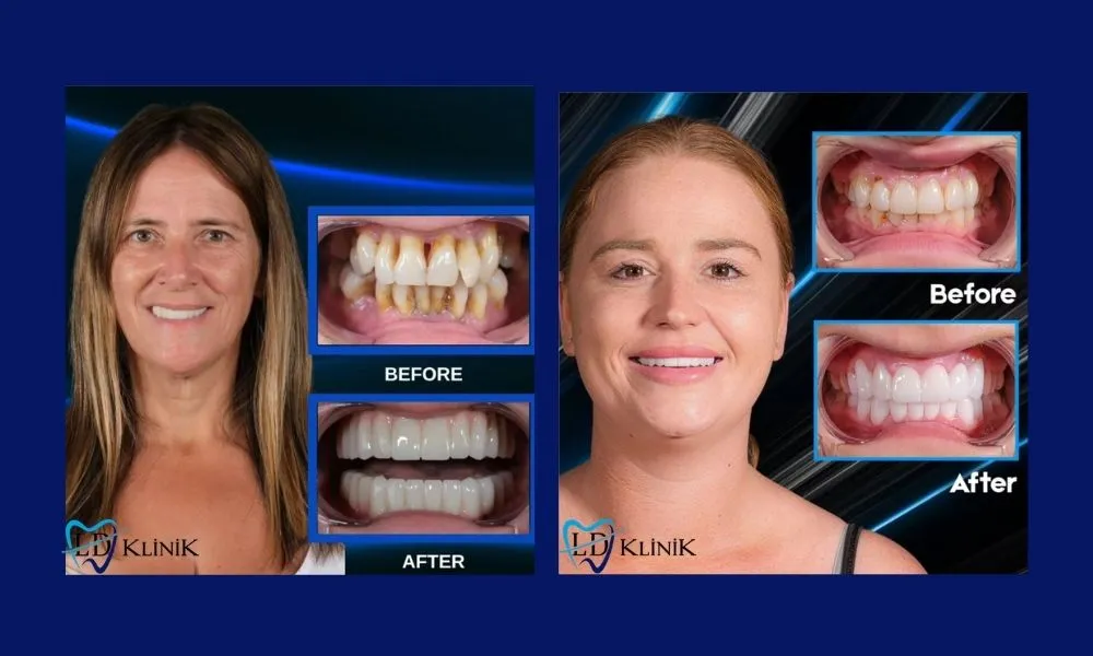 Zirconium crown before after in Antalya