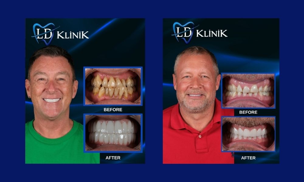 Zirconium crowns in Antalya